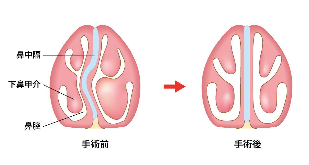 アレルギー性鼻炎の治療戦略 手術療法 奏の杜耳鼻咽喉科 千葉いびき 無呼吸クリニック