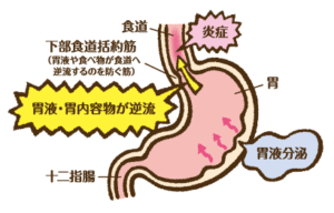 逆流性食道炎について